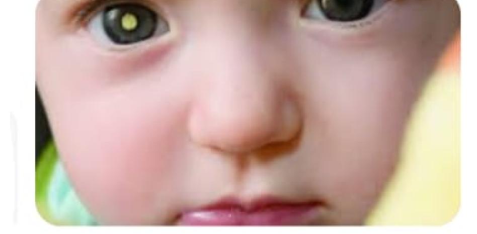 Retinoblastoma: cáncer ocular más común entre la población infantil