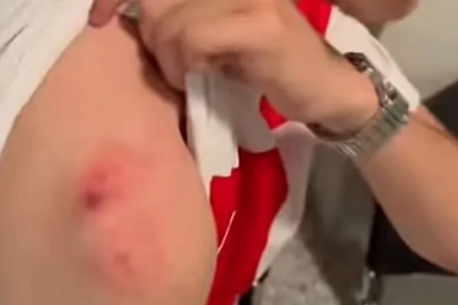 Sangre por una camiseta en la Eurocopa: una mujer muerde a un aficionado de Croacia