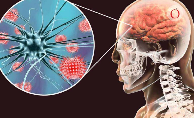 Alerta sanitaria en Europa: brote de meningitis en Reino Unido preocupa a las autoridades