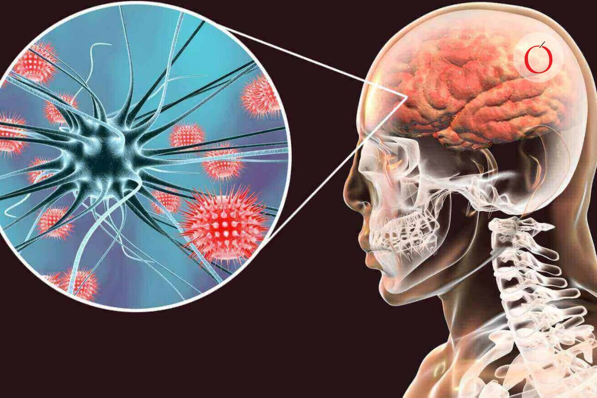 Alerta sanitaria en Europa: brote de meningitis en Reino Unido preocupa a las autoridades